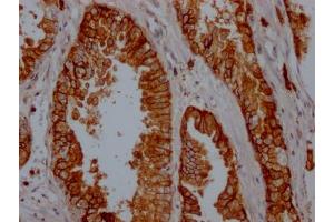 IHC image of ABIN7127402 diluted at 1:100 and staining in paraffin-embedded human prostate cancer performed on a Leica BondTM system.