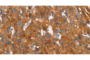 Immunohistochemistry of paraffin-embedded Human liver cancer tissue using Cytochrome b Polyclonal Antibody at dilution 1:30 (Cytochrome b anticorps)