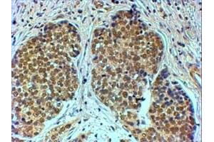 IHC testing of FFPE human breast cancer with TIF1A antibody at 4ug/ml. (TRIM24 anticorps)