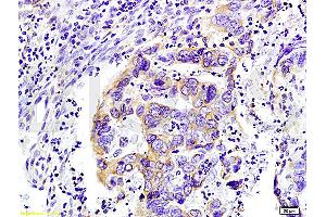 Formalin-fixed and paraffin-embedded : human colon carcinoma labeled with Rabbit Anti-WNK3 protein Polyclonal Antibody (ABIN675713), Unconjugated 1:200 followed by conjugation to the secondary antibody (WNK3 anticorps  (AA 451-550))