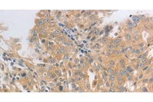 Immunohistochemistry of paraffin-embedded Human ovarian cancer tissue using HCRTR2 Polyclonal Antibody at dilution 1:50 (HCRTR2 anticorps)