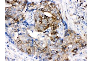 nti- Stathmin 1 Picoband antibody, IHC(P) IHC(P): Human Mammary Cancer Tissue