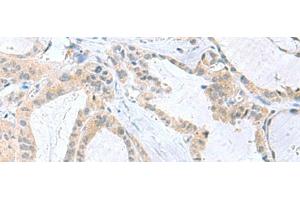 Immunohistochemistry of paraffin-embedded Human thyroid cancer tissue using PDE6D Polyclonal Antibody at dilution of 1:50(x200) (PDE6D anticorps)