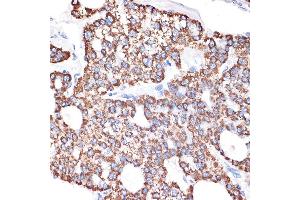Immunohistochemistry of paraffin-embedded human liver cancer using GABA transaminase (GABA transaminase (ABAT)) Rabbit mAb (ABIN7265336) at dilution of 1:100 (40x lens). (ABAT anticorps)