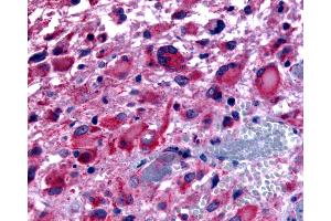 Anti-CHRM2 / M2 antibody IHC of human Brain, Glioblastoma. (Muscarinic Acetylcholine Receptor M2 anticorps  (Cytoplasmic Domain))