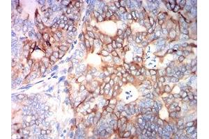 Immunohistochemical analysis of paraffin-embedded cervical cancer tissues using TUBB3 mouse mAb with DAB staining. (TUBB3 anticorps)
