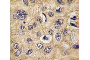 IHC analysis of FFPE human hepatocarcinoma tissue stained with Tuberin antibody (Tuberin anticorps  (AA 1776-1805))