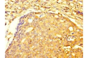 Immunohistochemistry of paraffin-embedded human gastric cancer using ABIN7173479 at dilution of 1:100 (TRIM74 anticorps  (AA 47-249))
