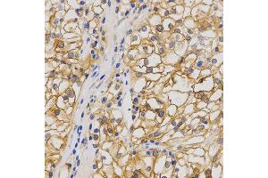 Immunohistochemistry of paraffin-embedded human stomach cancer using GRIA1 antibody at dilution of 1:200 (x400 lens) (Glutamate Receptor 1 anticorps  (AA 19-300))