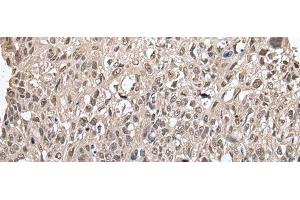 Immunohistochemistry of paraffin-embedded Human lung cancer tissue using METAP1D Polyclonal Antibody at dilution of 1:60(x200) (MAP1D anticorps)