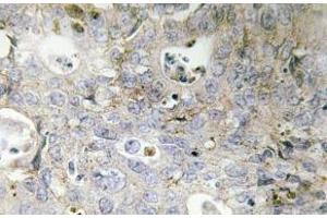 Immunohistochemistry (IHC) analyzes of Laminin gamma-1 antibody in paraffin-embedded human colon carcinoma tissue. (Laminin gamma 1 anticorps)