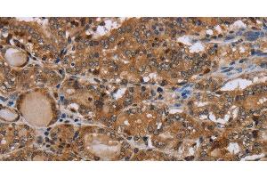 Immunohistochemistry of paraffin-embedded Human thyroid cancer using MT-ND1 Polyclonal Antibody at dilution of 1:50