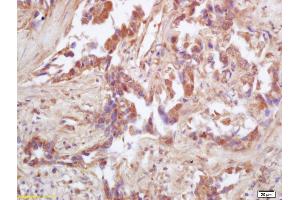Formalin-fixed and paraffin embedded human lung carcinoma labeled with Rabbit Anti IDH2 Polyclonal Antibody, Unconjugated (ABIN751558) at 1:200 followed by conjugation to the secondary antibody and DAB staining (IDH2 anticorps  (AA 251-350))