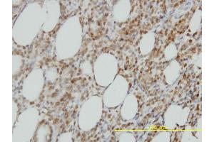 Immunoperoxidase of monoclonal antibody to ISGF3G on formalin-fixed paraffin-embedded human malignant lymphoma, diffuse large B tissue. (IRF9 anticorps  (AA 1-393))