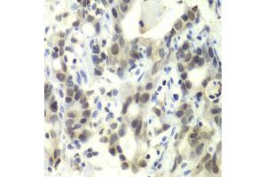 Immunohistochemistry of paraffin-embedded human gastric cancer using E2F6 antibody. (E2F6 anticorps)