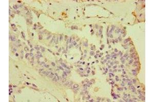 Immunohistochemistry of paraffin-embedded human endometrial cancer using ABIN7148730 at dilution of 1:100