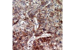 Immunohistochemical analysis of CD208 staining in human lung cancer formalin fixed paraffin embedded tissue section.