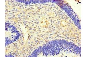 Immunohistochemistry of paraffin-embedded human ovarian cancer using ABIN7143204 at dilution of 1:100 (ACSF3 anticorps  (AA 365-484))