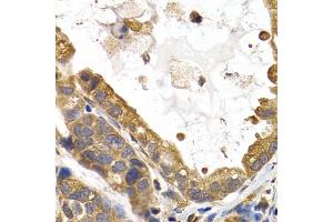Immunohistochemistry of paraffin-embedded human stomach cancer using GYS1 antibody (ABIN5971351) at dilution of 1/200 (40x lens). (Glycogen Synthase 1 anticorps)
