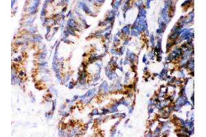 IHC analysis of Cathepsin D using anti-Cathepsin D antibody (ABIN3044509).