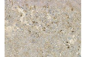 ABIN6259506 and ABIN6273982 at 1/100 staining human melanoma by IHC-P.