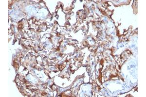 Formalin-fixed, paraffin-embedded human Melanoma stained with MCAM Mouse Monoclonal Antibody (MCAM/1101).