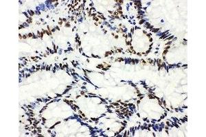 IHC-P: HDAC3 antibody testing of human intestinal cancer tissue (HDAC3 anticorps  (AA 411-428))