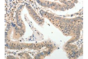 The image on the left is immunohistochemistry of paraffin-embedded Human colon cancer tissue using ABIN7189660(ADAMTS2 Antibody) at dilution 1/25, on the right is treated with synthetic peptide.