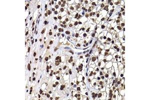 Immunohistochemistry of paraffin-embedded human kidney cancer using DNAJB6 antibody.