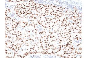 Formalin-fixed, paraffin-embedded human Breast Carcinoma stained with Progesterone Receptor Mouse Monoclonal Antibody (PR500). (Progesterone Receptor anticorps)