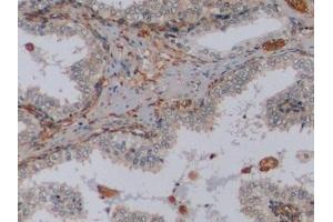 Detection of VIM in Human Prostate Tissue using Monoclonal Antibody to Vimentin (VIM)