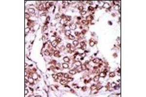 Formalin-fixed and paraffin-embedded human cancer tissue reacted with the primary antibody, which was peroxidase-conjugated to the secondary antibody, followed by AEC staining.