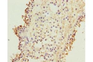 Immunohistochemistry of paraffin-embedded human breast cancer using ABIN7157640 at dilution of 1:100 (KIF26B anticorps  (AA 8-133))
