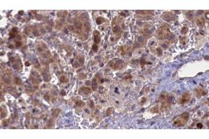 ABIN6276849 at 1/100 staining Human liver cancer tissue by IHC-P. (CHRNA5 anticorps  (Internal Region))