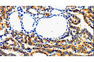 Immunohistochemistry of paraffin-embedded Human thyroid cancer using AIMP2 Polyclonal Antibody at dilution of 1:50