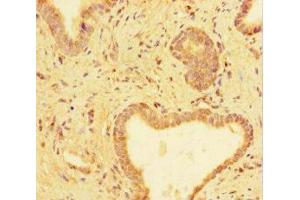Immunohistochemistry of paraffin-embedded human prostate cancer using ABIN7173659 at dilution of 1:100 (TUBA1C anticorps  (AA 29-184))
