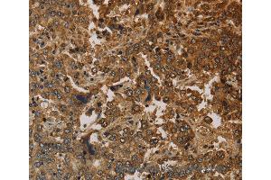 Immunohistochemistry of Human liver cancer using KRT16 Polyclonal Antibody at dilution of 1:30 (KRT16 anticorps)