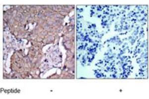 Immunohistochemical analysis of paraffin-embedded human breast carcinoma tissue using ERBB2 polyclonal antibody  . (ErbB2/Her2 anticorps)