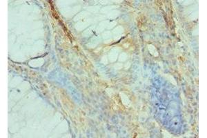 Immunohistochemistry of paraffin-embedded human colon cancer using ABIN7152531 at dilution of 1:100
