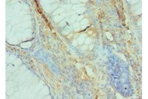 Immunohistochemistry of paraffin-embedded human colon cancer using ABIN7152531 at dilution of 1:100 (GFER anticorps  (AA 81-205))
