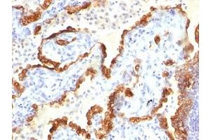 Formalin-fixed, paraffin-embedded human lung carcinoma stained with Cytokeratin 18 antibody.