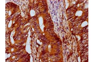 IHC image of ABIN7156973 diluted at 1:400 and staining in paraffin-embedded human colon cancer performed on a Leica BondTM system. (IFT172 anticorps  (AA 1368-1502))