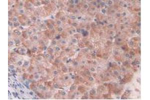 IHC-P analysis of Human Liver Cancer Tissue, with DAB staining. (HIF1A anticorps  (AA 218-506))