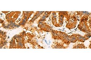 Immunohistochemistry of paraffin-embedded Human thyroid cancer tissue using ASMTL Polyclonal Antibody at dilution of 1:100(x200) (ASMTL anticorps)