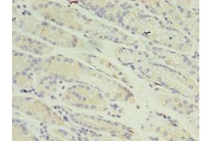 Immunohistochemistry of paraffin-embedded human gastric cancer using ABIN7150974 at dilution of 1:100 (RANBP2 anticorps  (AA 2601-2802))