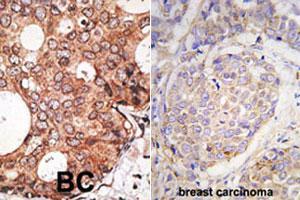 Formalin-fixed and paraffin-embedded human breast carcinoma tissue reacted with MAGEA10 polyclonal antibody  , which was peroxidase-conjugated to the secondary antibody, followed by DAB staining. (MAGEA10 anticorps  (C-Term))
