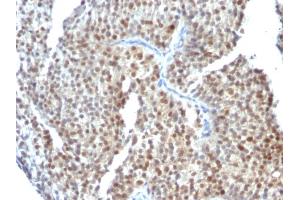 Formalin-fixed, paraffin-embedded human Bladder Carcinoma stained with ER-beta Mouse Monoclonal Antibody (ESR2/686). (ESR2 anticorps  (C-Term))