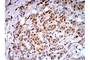 Immunohistochemical analysis of paraffin-embedded breast cancer tissues using PSMC3 mouse mAb with DAB staining.
