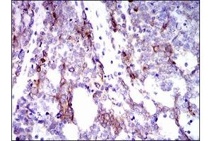 Immunohistochemical analysis of paraffin-embedded esophageal cancer tissues using CK5 mouse mAb with DAB staining. (Cytokeratin 5 anticorps  (AA 316-590))