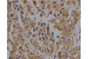 Immunohistochemical staining of human liver cancer tissue section with PRDX6 monoclonal antibody, clone 36  at 1:100 dilution. (Peroxiredoxin 6 anticorps)